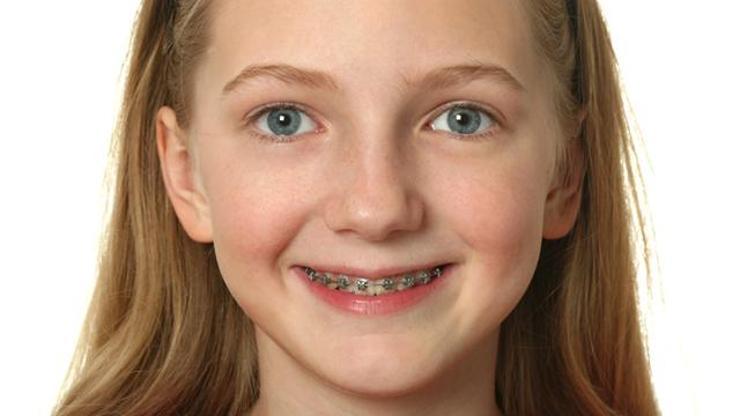 Çocuklarda ortodonti tedavi başlama yaşı nedir
