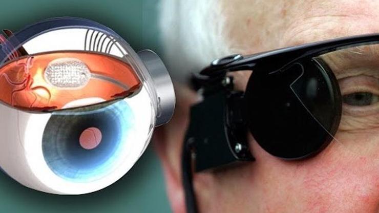 Biyonik Göz ameliyatı Türkiyede de uygulanacak