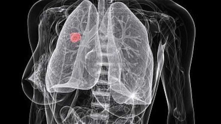 Akciğer kanseri,meme kanserinden daha fazla kadın öldürüyor