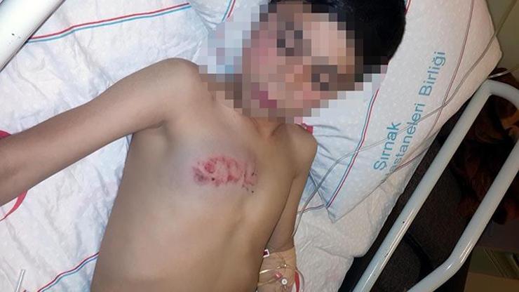 Cizrede 11 yaşındaki çocuk gaz fişeğiyle vuruldu