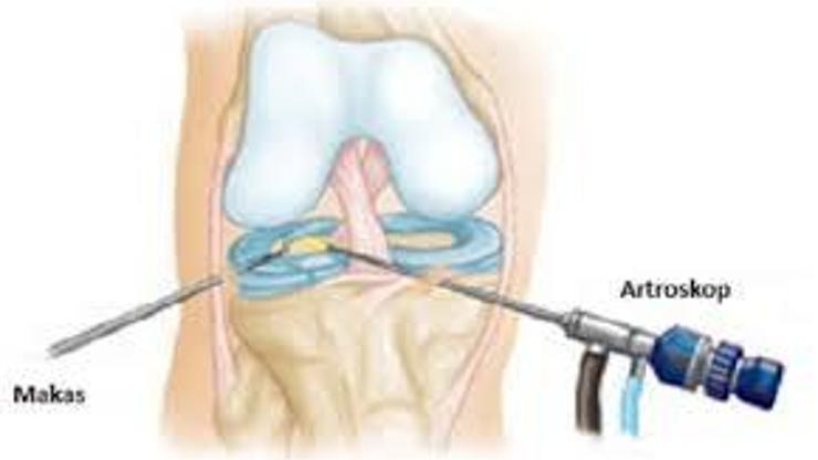 Diz protezi ameliyatı tek taraflı mı yoksa çift taraflı mı olunmalı