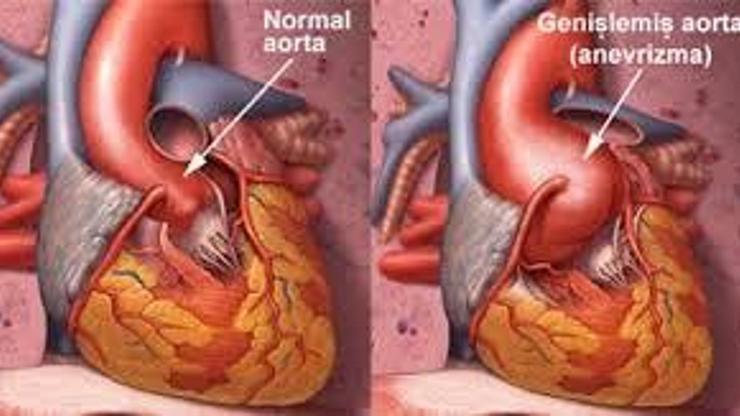 Aort kapak hastalığı nedir Nasıl tedavi edilir