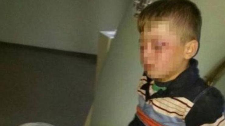 Cizrede 8 yaşındaki çocuk gözünden plastik mermiyle vuruldu