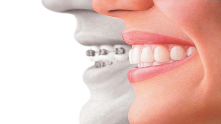 Telsiz ortodontik tedavi