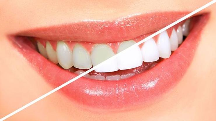 Diş beyazlatma nedir Yöntemleri nelerdir