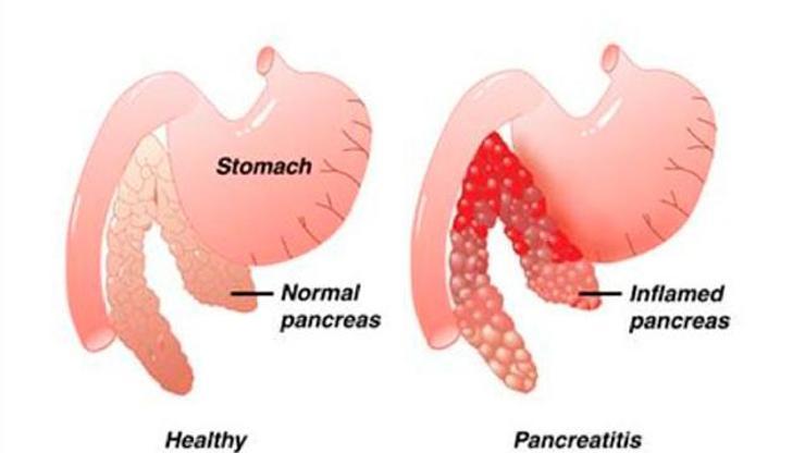 Pankreas kanseri belirtileri nelerdir