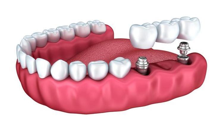 Diş implantları nasıl uygulanır