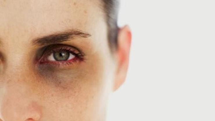 Göz altı morlukları neden olur ve nasıl geçer