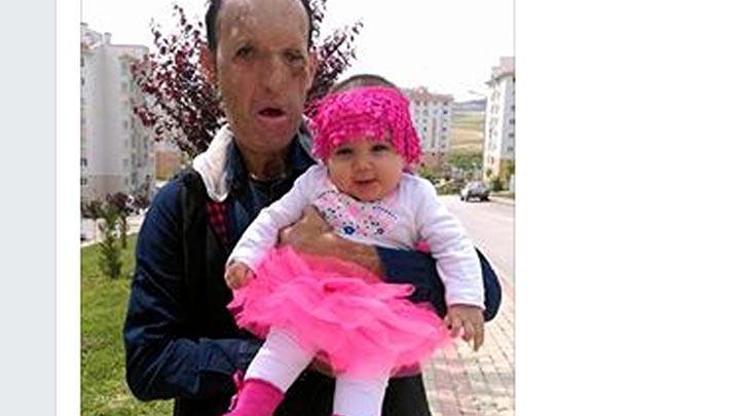 Yüz nakli olan baba kızıyla fotoğrafını paylaştı