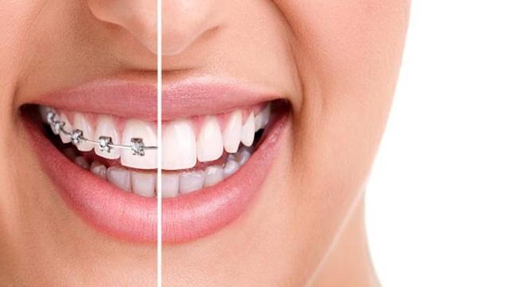 Kısa sürede diş teli tedavisi: Fastbraces