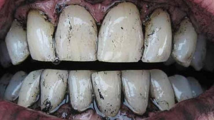 Kömürün dişleri beyazlattığına dair hiçbir bilimsel kanıt yok