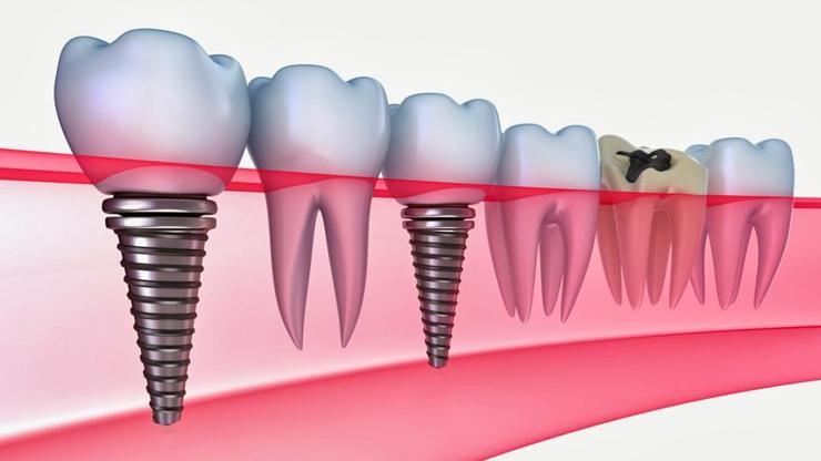 Tam dişsiz çenelerde implant tedavisi