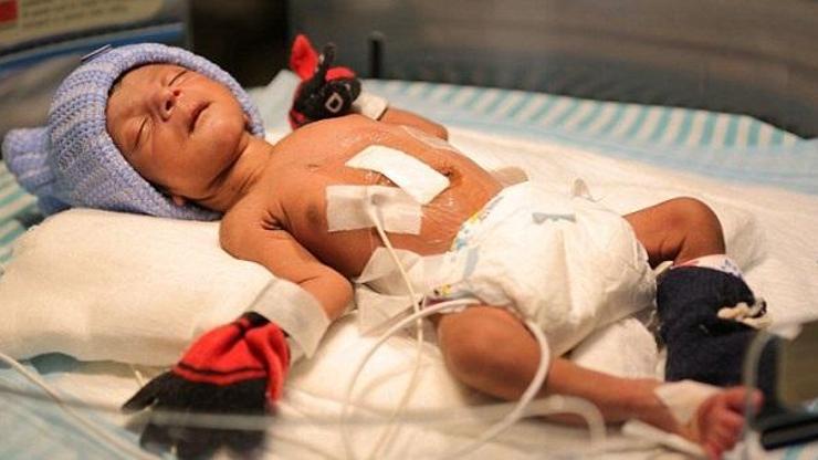 Hindistanda dört ayaklı doğan bebek ameliyat edildi