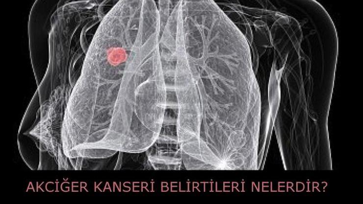 Akciğer kanseri nedir Belirtileri nelerdir