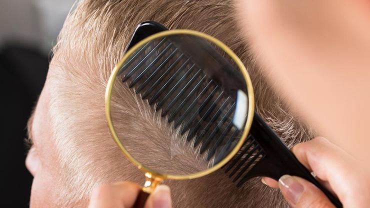 Saç dökülmesinde PRP uygulamalarının faydaları