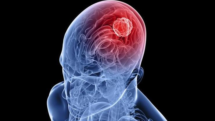 Agresif beyin kanseri tümörlerinin tedavisinde ümit veren keşif