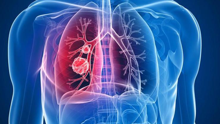 Türkiye’de her gün 350 kişi akciğer kanserinden ölüyor
