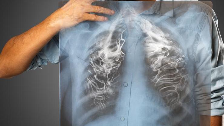 Uzmanlar: Akciğer kanserinin yüzde 90ı sigaradan
