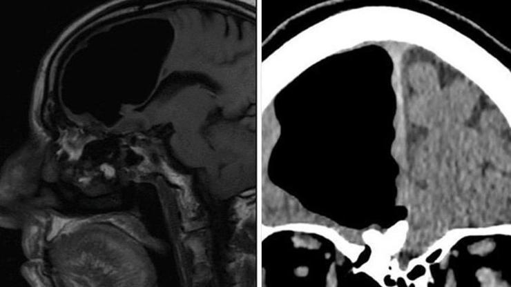 Baş ağrısıyla hastaneye gitti, röntgen sonuçları inanılmaz gerçeği ortaya çıkardı