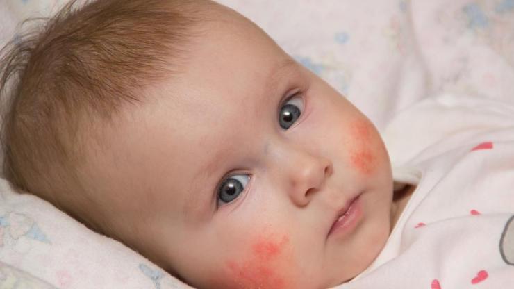 Bebeğinizi besin alerjisinden nasıl korursunuz
