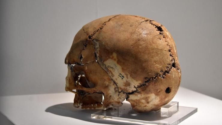 İşte 10 bin yıl önce ilk beyin ameliyatı yapılan kafatası