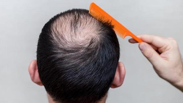 Erkeklerin büyük sorunu saç dökülmesi