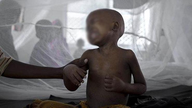 Etiyopyada kolera salgını: 16 ölü