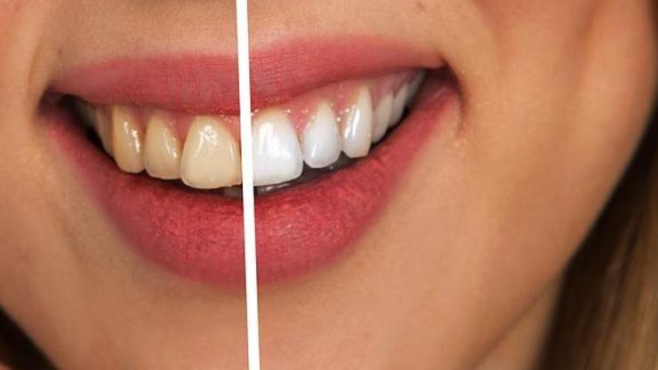Dişlerde oluşan sararmalar kabusunuz olmasın