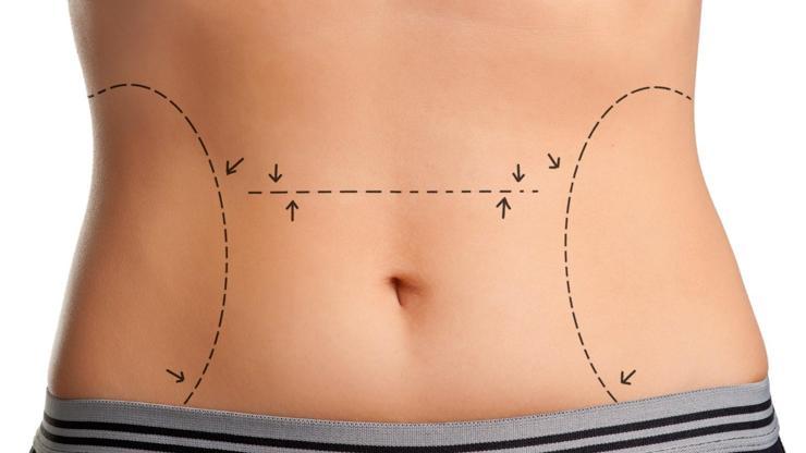 Liposuction zayıflama yöntemi değildir