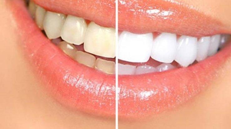 Diş beyazlatma işlemi dişlere zarar verir mi