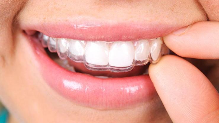 Ortodonti tedavisinde saklı tel nedir