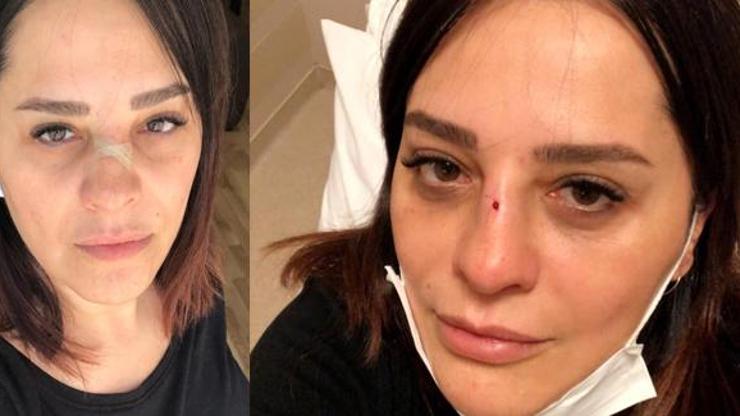 Şarkıcı Reyhan Karacanın burnu kırıldı