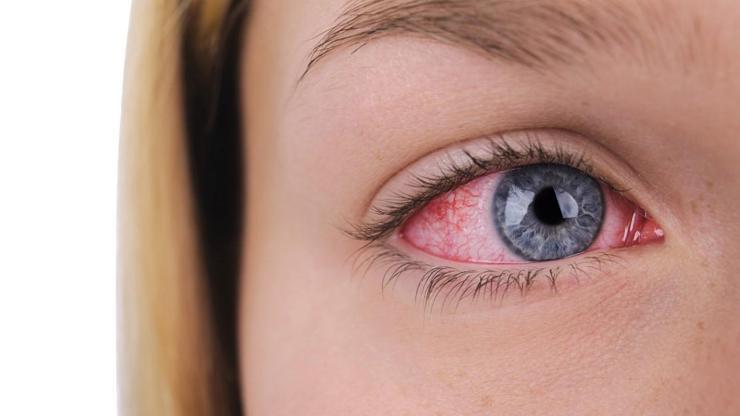 Uzman isim Çok sık görülmüyor diyerek uyardı: Koronavirüste ‘kırmızı göz’ belirtisi