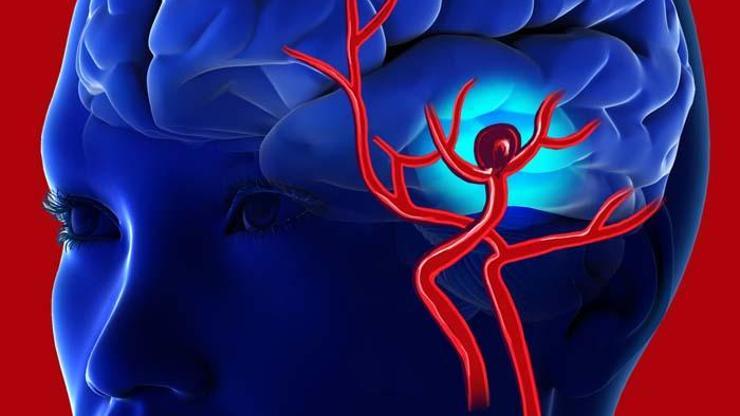 Beyin anevrizması nedir Beyin kanamasına yol açıyor Bu 4 kritik belirtiye dikkat