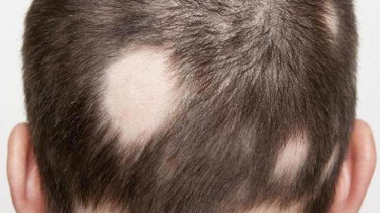 Saçkıran (Alopesi Areata) Nedir Saçkıranın Belirtileri Nelerdir, Tedavisi Nasıl Yapılır