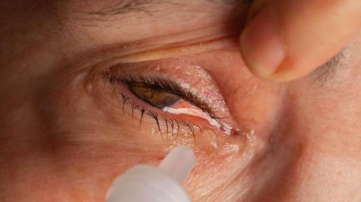 Göz Nezlesi Nedir, Neden Olur Göz Nezlesi Nasıl Geçer, Tedavisi Nasıl Yapılır