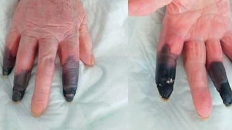 Koronavirüs hastası kadın kangren oldu, 3 parmağı kesildi