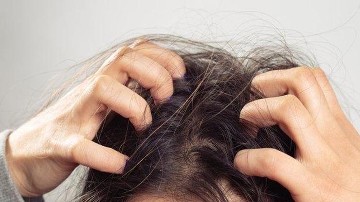Saç Derisi Kaşıntısı Neden Olur, Neyin Belirtisidir Saç Kaşıntısı Nasıl Geçer