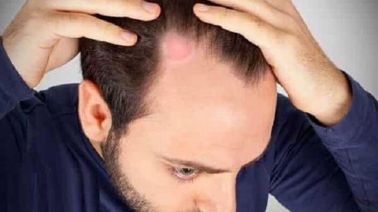 Saçkıran (Alopesi Areata) Nedir, Neden Olur Saçkıran Belirtileri Nelerdir, Nasıl Tedavi Edilir