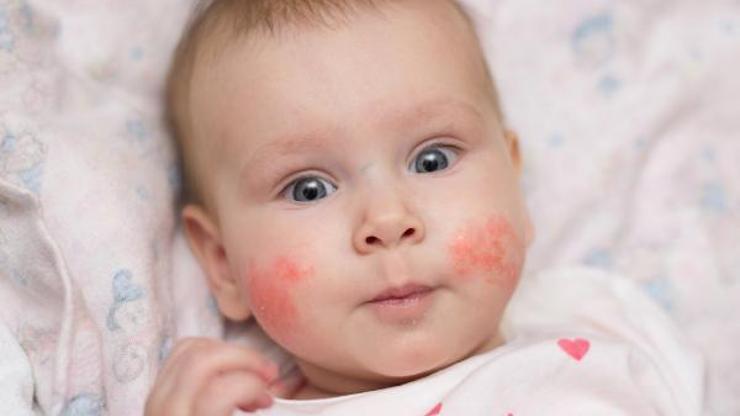 Bebeğinize sürdüğünüz krem besin alerjisi yapabilir