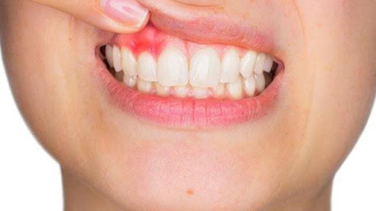 Diş Eti Kanaması Abdesti Bozar Mı Diş Etinde Kanama Olan Kişinin Abdesti Bozulur Mu