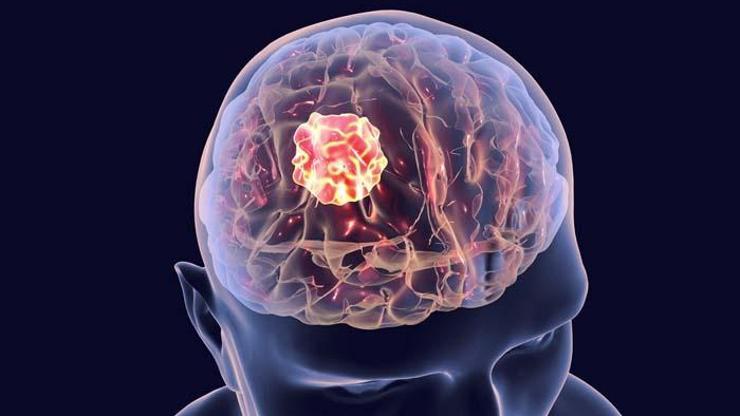 Beyin tümörünün 6 erken belirtisi Cep telefonlarına dikkat Beyin tümörüne neden oluyor