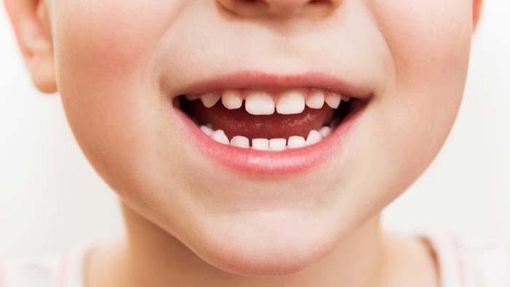 Çocuklarda diş sorunları iştahsızlığa neden olabiliyor
