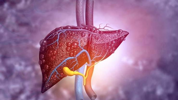 Viral hepatitler karaciğeri vuruyor Bulaş yollarına dikkat