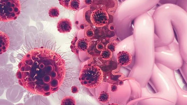 Kolon kanserinde sık görülen 8 değişiklik... Kolon kanseri belirtileri neler