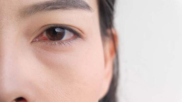 Şeker hastalarında görülüyor Göz içi kanamalarına dikkat