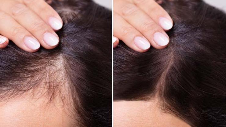 Saç dökülmesi kök hücre yöntemiyle engellenebilir