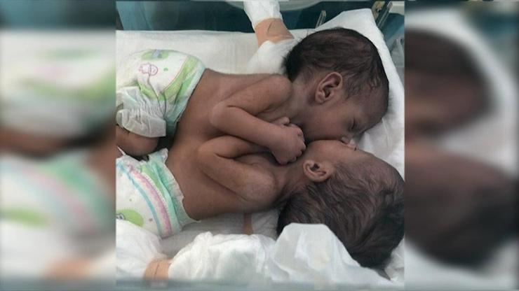 Yemenli yapışık ikizlerden haber var