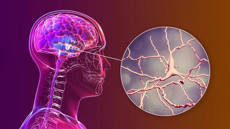 Parkinson gençlerde de görülüyor