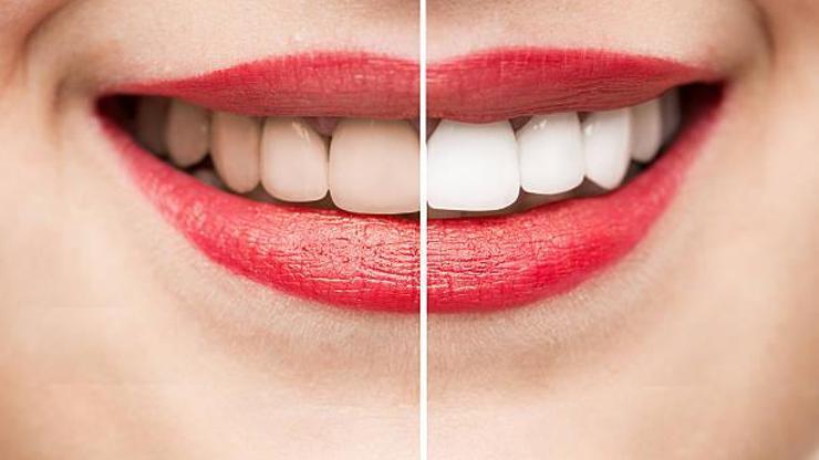 Bilinçsiz beyazlatma dişlerde hasar bırakabiliyor